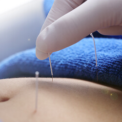 img-services-acupuncture