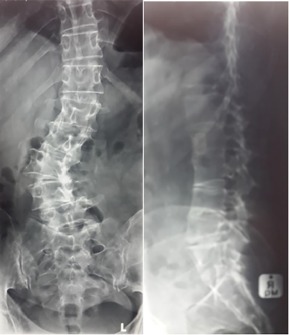 degenerative scolisos xray