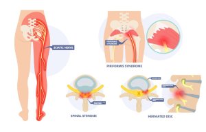 Causes-of-Sciatica