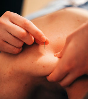 Acupuncture at Kinstruct Health Chiropractic & Wellness