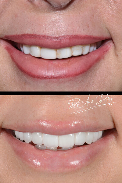 before and after smile
