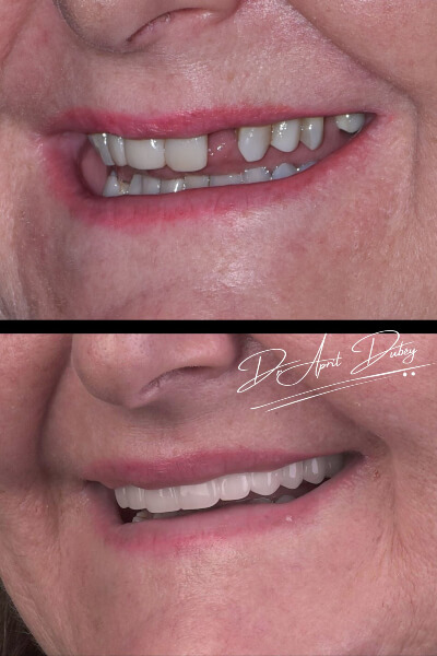 before and after smile