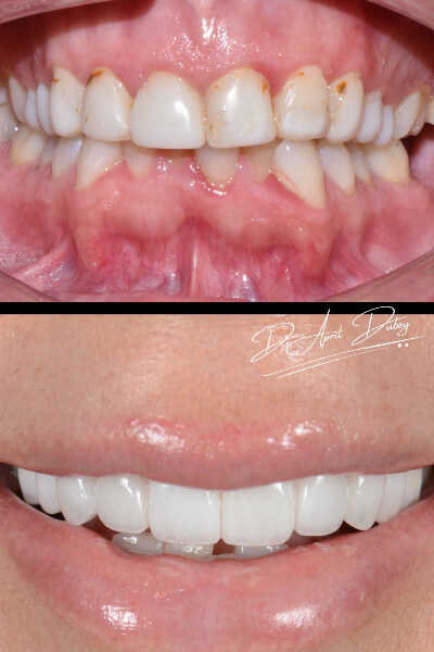 before and after smile