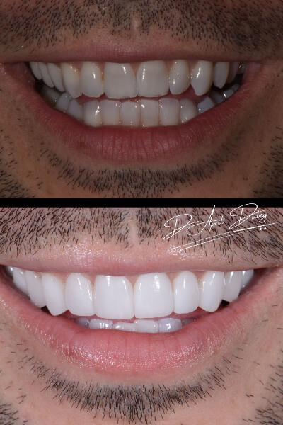 before and after smile