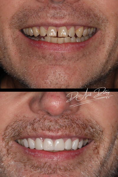 before and after smile