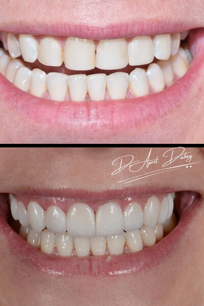 before and after smile