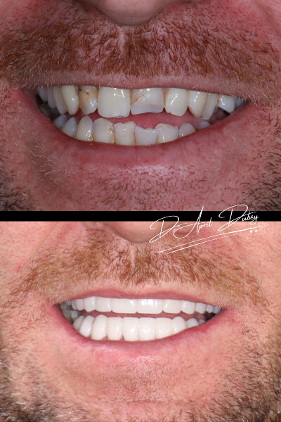 before and after smile