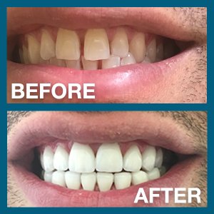 Man's smile before and after procedure