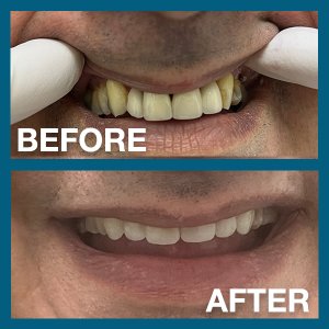 Old man's teeth before and after procedure