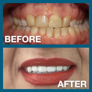 Woman's dental procedure before and after smile