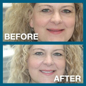 Woman's smile before and after procedure