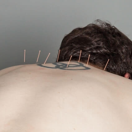 Acupuncture needles on back