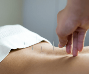 A patient receives acupuncture in Saskatoon
