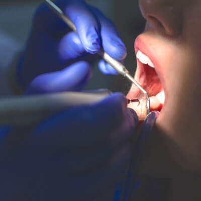Looking inside patient's mouth
