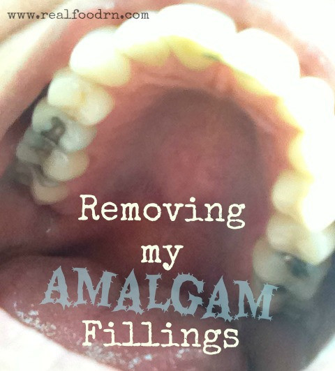 removing-my-amalgam-fillings