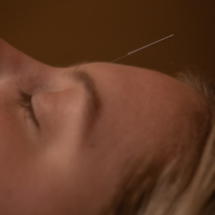 Dry needle in woman's forehead