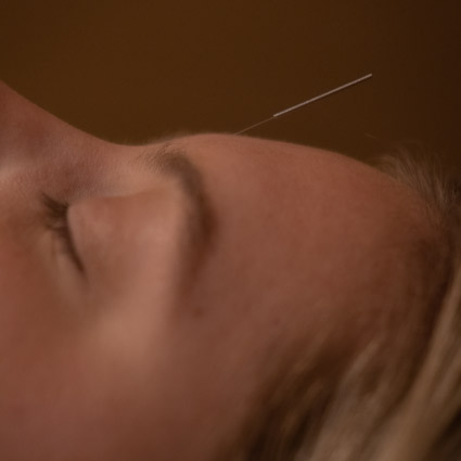 Cold Laser Therapy & Trigger Point Dry Needling