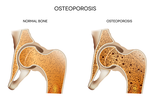 Loveland,CO Chiropractor Osteoprosis