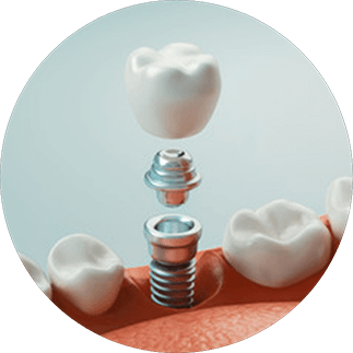 Illustration of dental implants