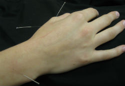Marion Acupuncture