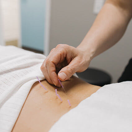 Dry needling on back