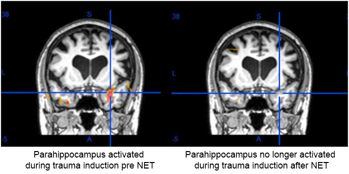 pre-and-post-fmri-cancer-study-001