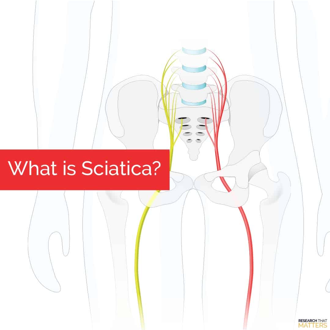 Week 1 - What is Sciatica