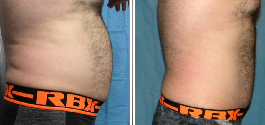 Male stomach before and after Zerona