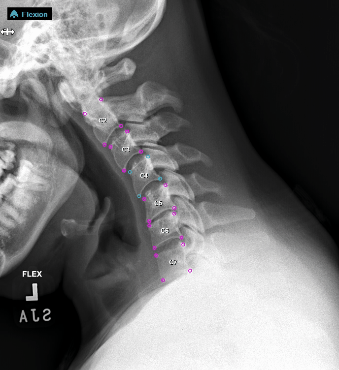 3 Cervical FE C4 Stabilized.