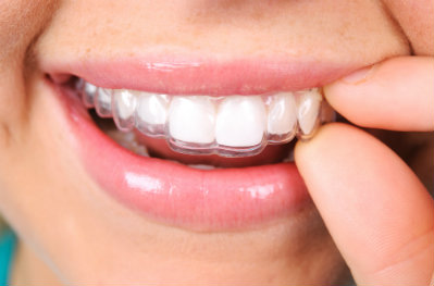 Invisalign orthodontics