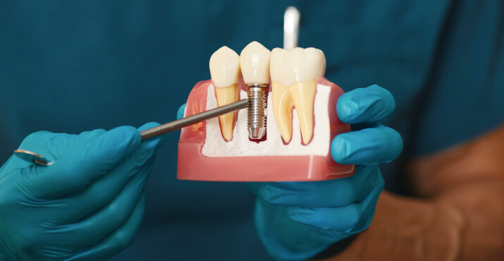 img-guided-dental-implants