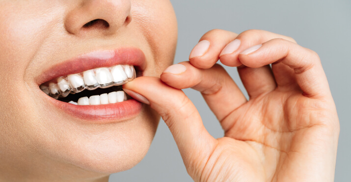 img-invisalign