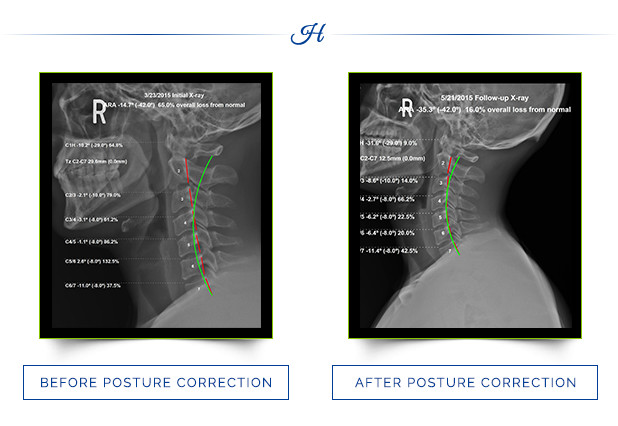 The Maintenance of Upright Posture - Straight Spine Chiropractic Courtenay  and Campbell River