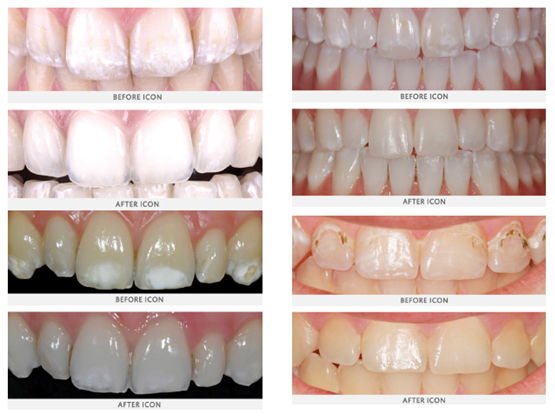 Icon® Dental Treatment, White Spots and Discolored Tooth Treatment