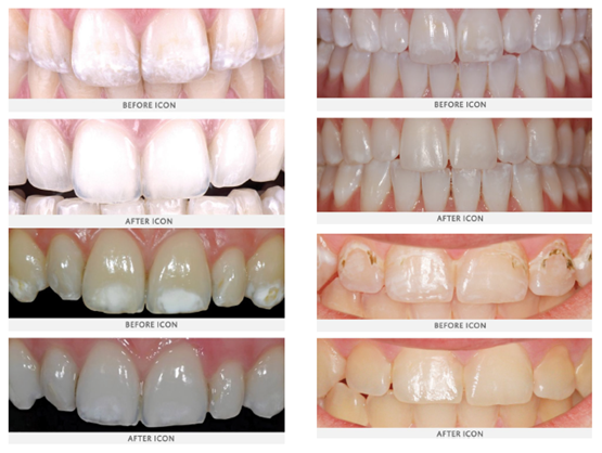 How Much Does Icon Dental Treatment Cost Stamdifer