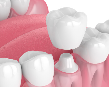 Dental Crown illustration