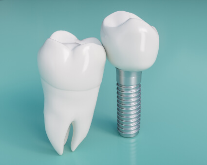 Dental Implants illustration