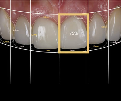 digital smile design