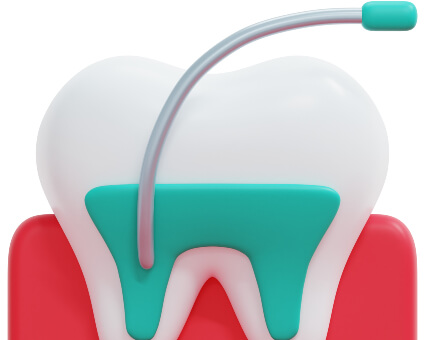 Root Canal Treatment illustration