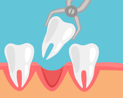 Tooth Extraction illustration