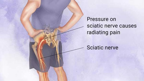 Sciatica: Of all the nerve - Harvard Health