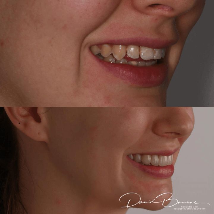 Veneers-18.6.21-2-720x720