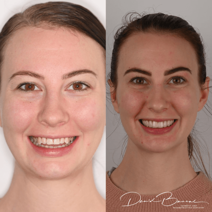 Veneers-18.6.21-720x720