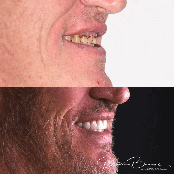 Veneers-20.6.21-2-720x720