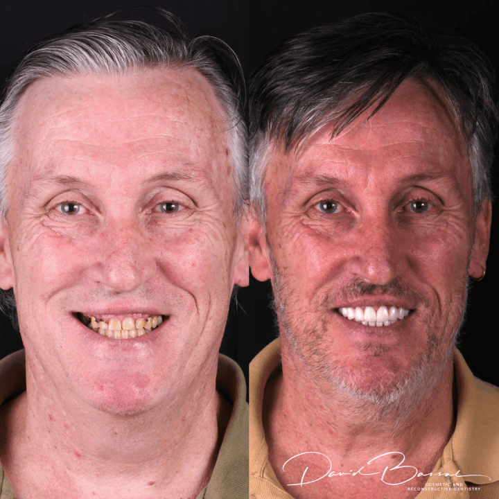 Veneers-20.6.21-720x720