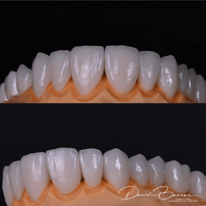 Veneers-25.6.21-2-720x720