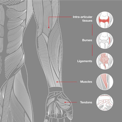 arthritis illustration