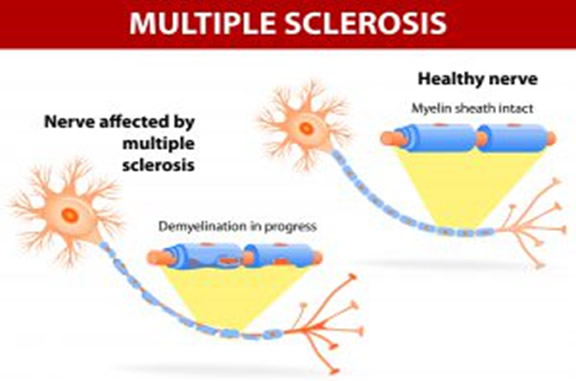 multiple sclerosis illustration