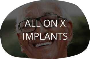 All on X Implants
