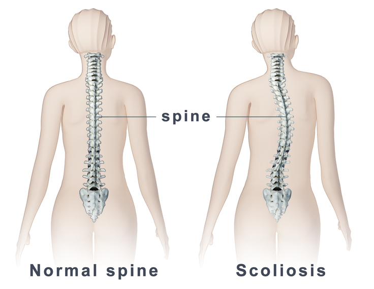 large_spine_scoliosis